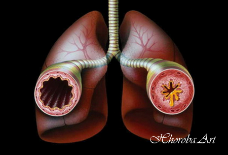 Бронхіальна астма - класифікація, клінічні ознаки, лікування, муколітична терапія, стадії, профілактика і прогноз